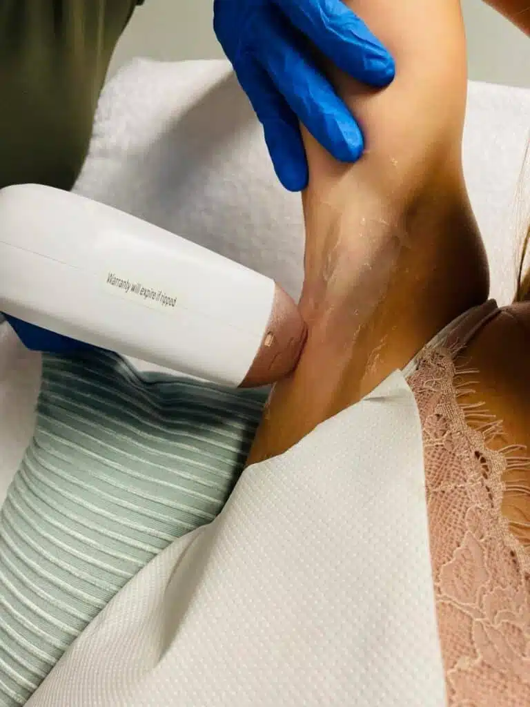 Pièce à main du LASERSKIN pendant une épilation