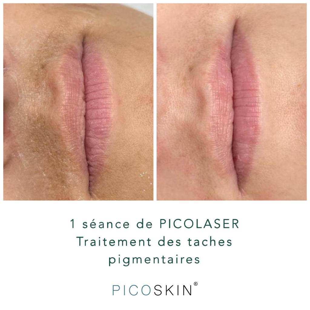 PICOSKIN-rajeunissement-cutane