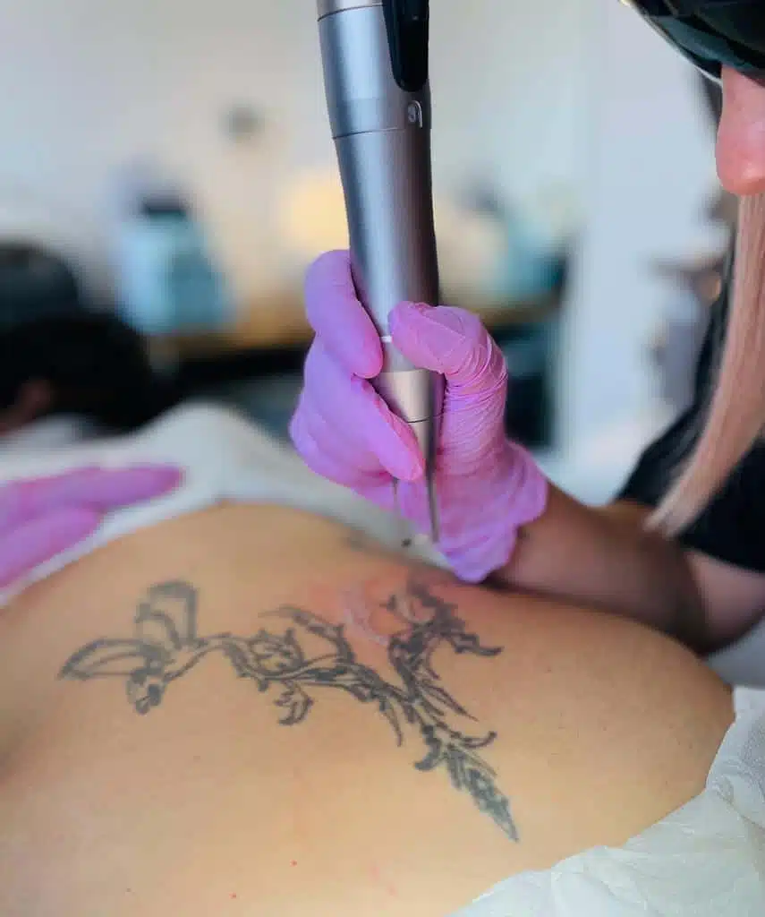 Détatouage au laser sur un tatouage de la cuisse