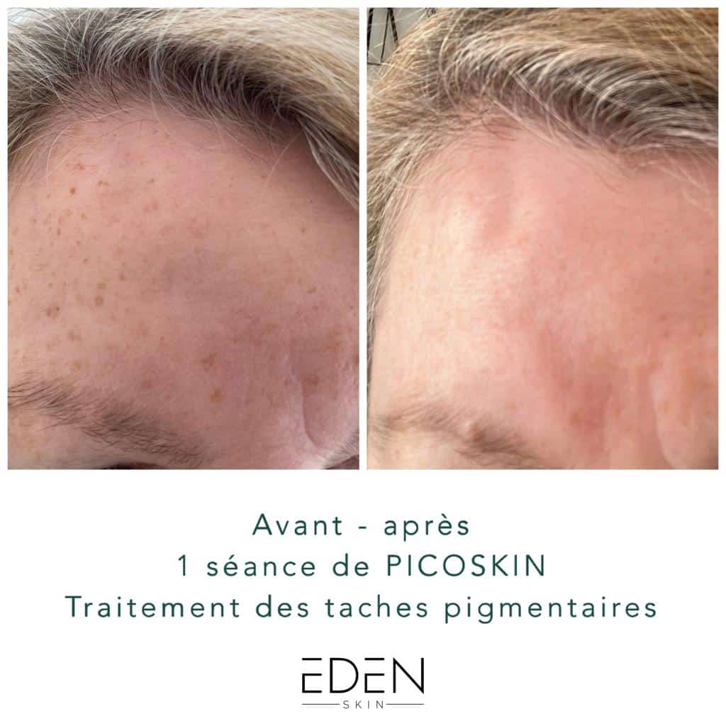 PICOSKIN-rajeunissement-cutan