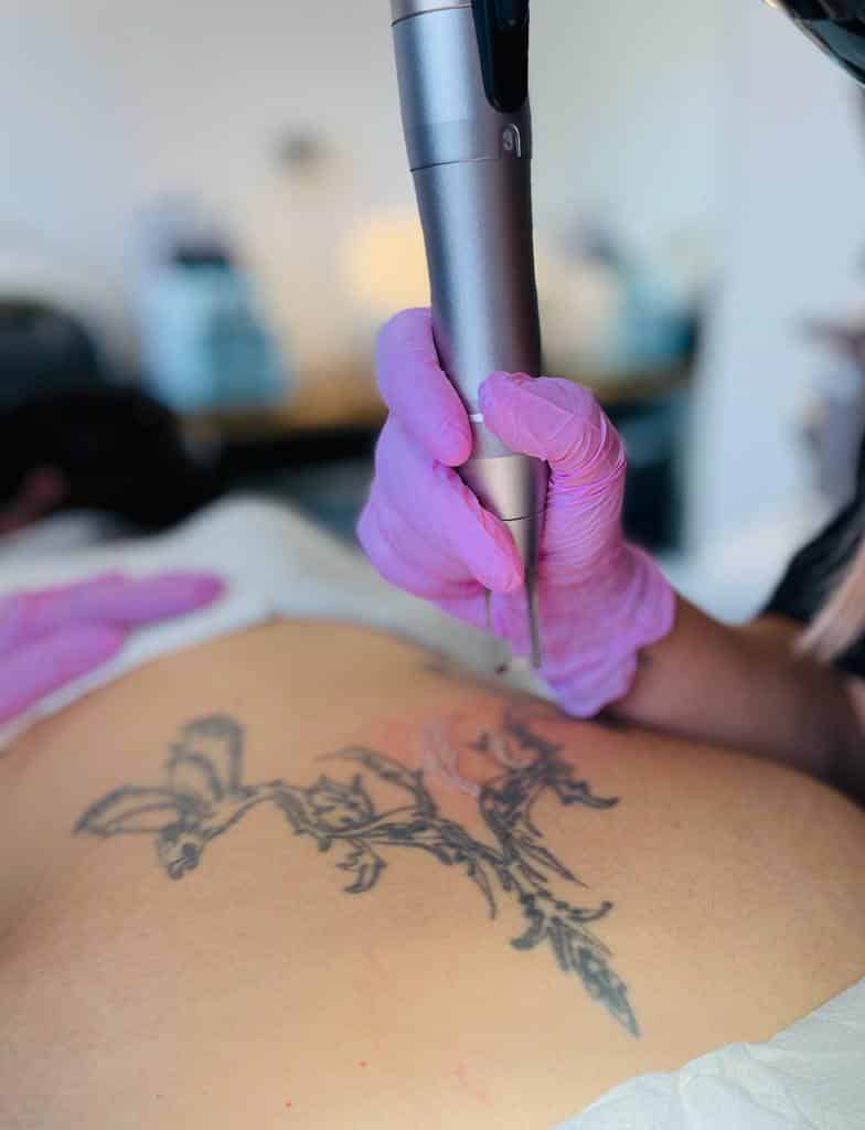 PICOSKIN-detatouage-02-1