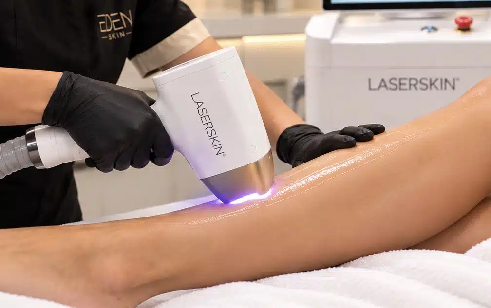 Épilation laser des jambes avec le LASERSKIN